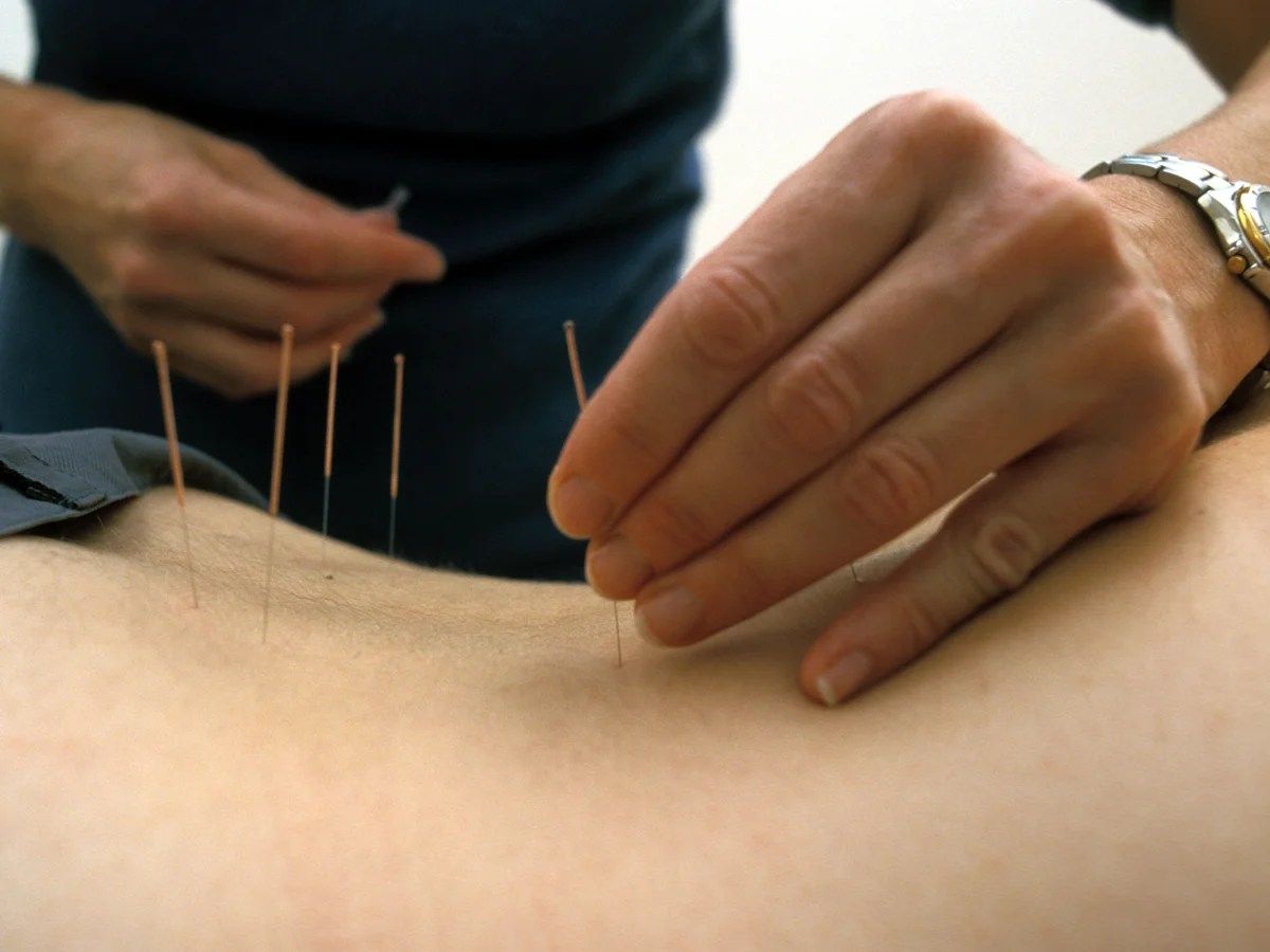 Acupuncture