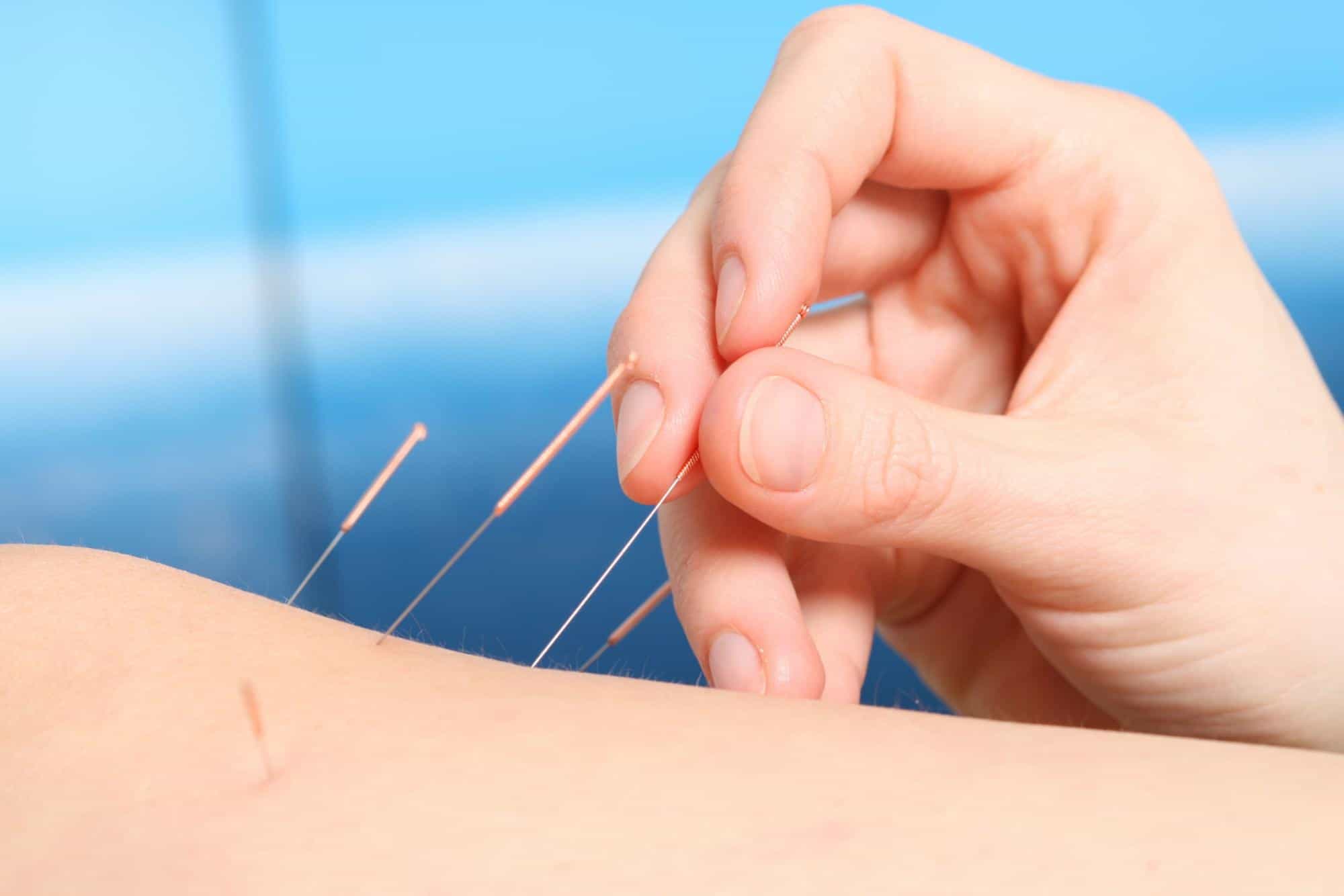 Realizing the variations between acupuncture and dry needling for healing